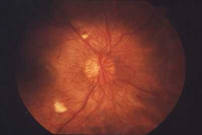Diabetická retinopatia