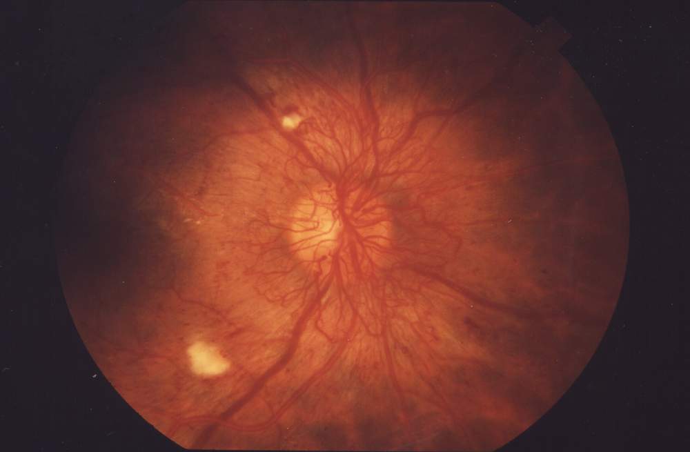 diabeticka retinopatia