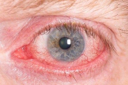 Close up of wide open red and irritated human eye