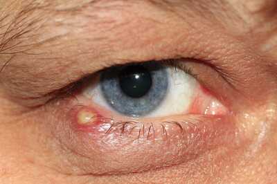 Najčastejšie zápaly a infekcie oka
