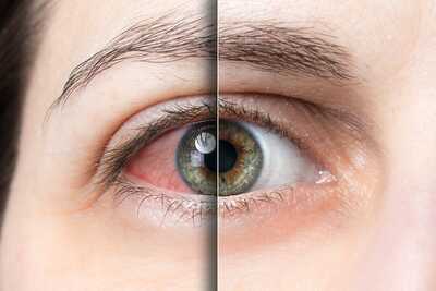 Suché oko (syndróm suchého oka)